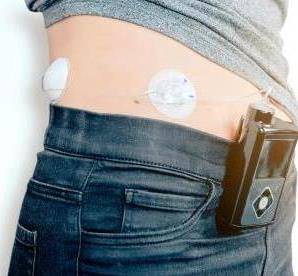 Vrouw met diabetes draagt Medtronic Enlite CGM glucosesensor en Medtronic MiniMed insulinepomp op haar buik