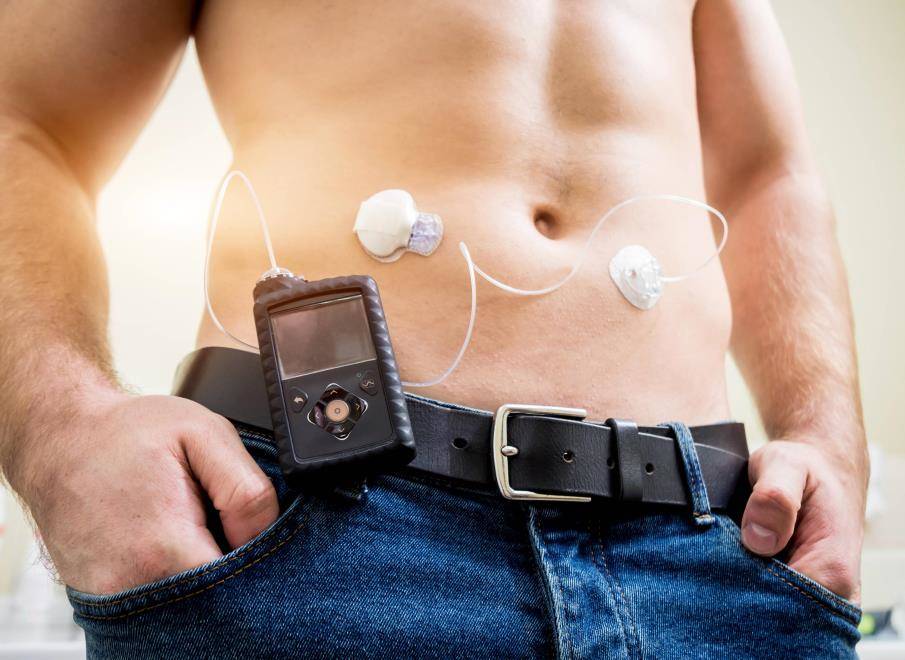 Man met diabetes draagt Medtronic insulinepomp met Enlite glucosesensor CGM