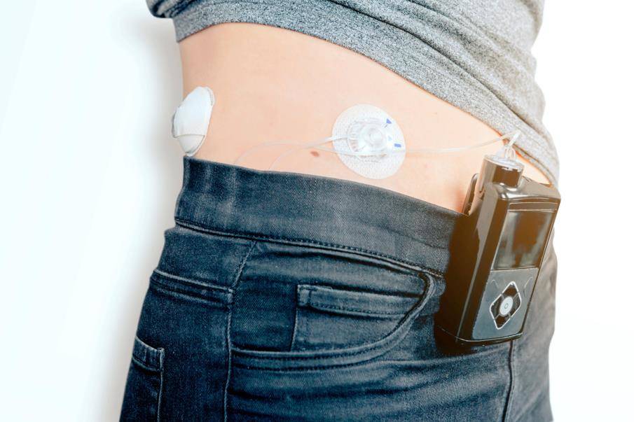 Vrouw met diabetes draagt Medtronic Enlite CGM glucosesensor en Medtronic MiniMed insulinepomp op haar buik