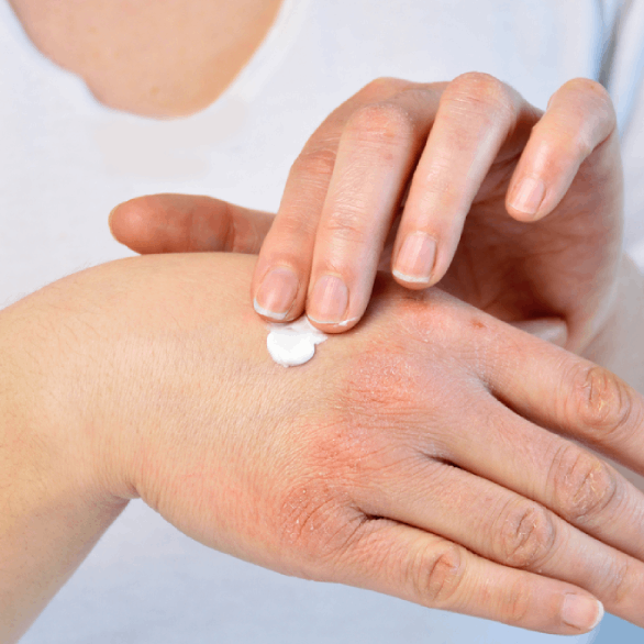 Creme smeren op een huidaandoening