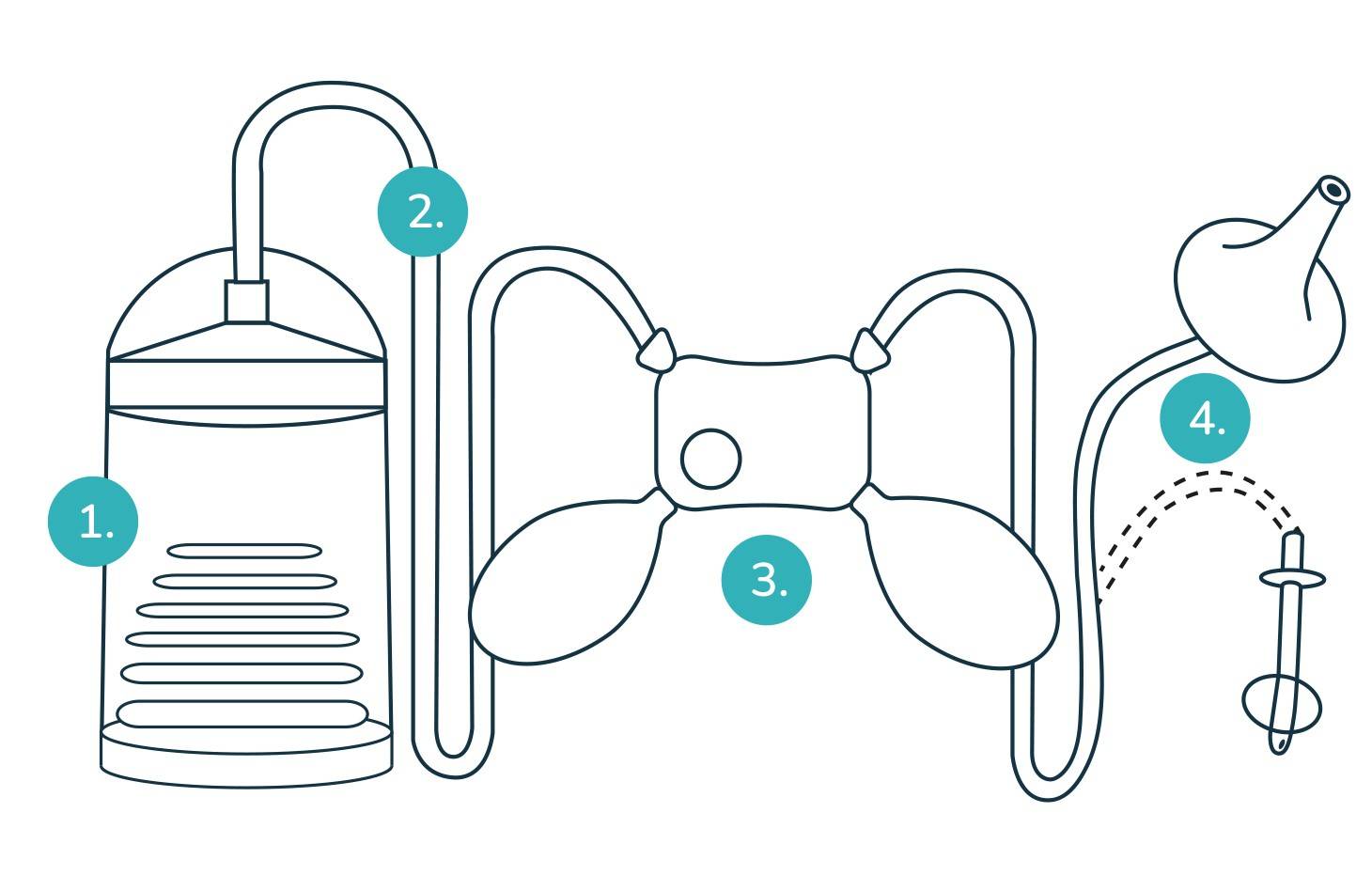 Kenmerken van een handpomp voor stoma irrigeren